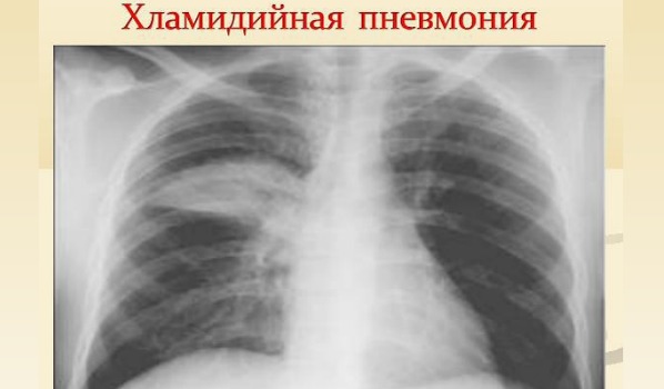 Причини, ознаки та лікування атипових пневмоній