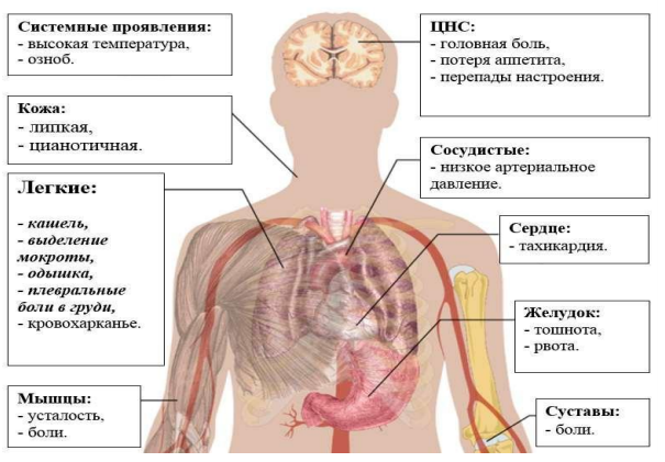 Причини, ознаки та лікування атипових пневмоній