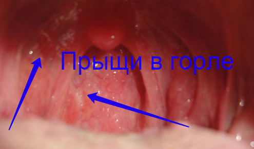 Причини появи і лікування прищів в горлі