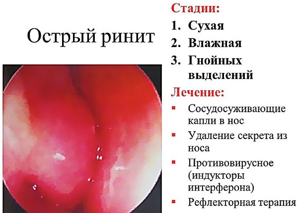 Причини появи золотистого стафілокока в носі і його лікування
