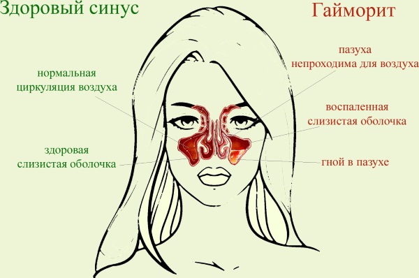 Причини появи золотистого стафілокока в носі і його лікування
