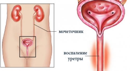 Причини симптоми і лікування алергічного уретриту