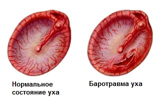 Причини симптоми і лікування баротравми вуха баротравматического отиту