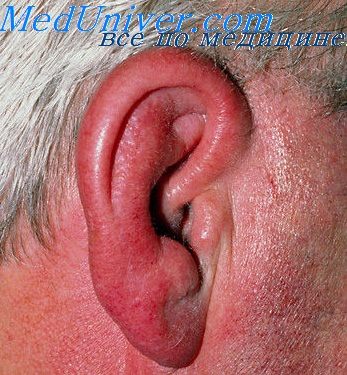 Причини, симптоми і лікування бешихового запалення вуха. Як виглядає і лікується бешихове запалення вушної раковини? Рожа вуха лікування