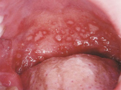 Причини симптоми і лікування герпесной ангіни у дітей і дорослих