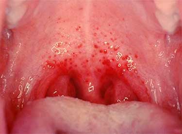 Причини симптоми і лікування герпесной ангіни у дітей і дорослих