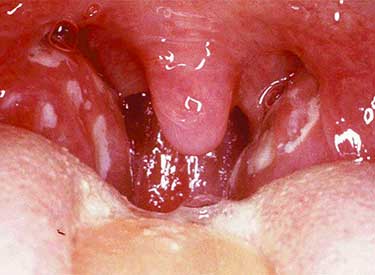 Причини симптоми і лікування герпесной ангіни у дітей і дорослих