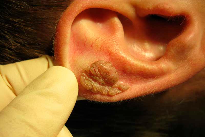 Причини симптоми і лікування гломусной пухлини середнього вуха