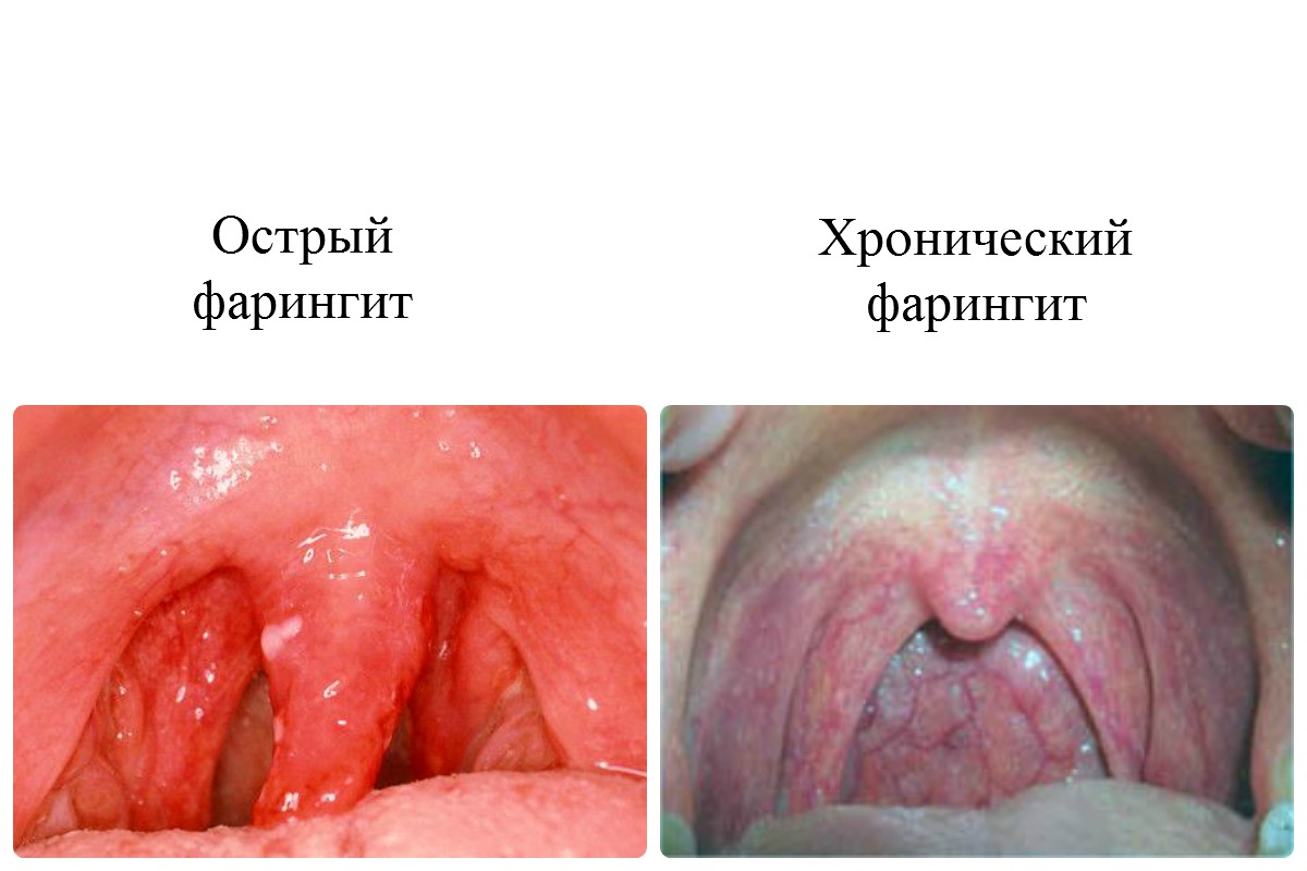 Причини симптоми і лікування гнійного фарингіту
