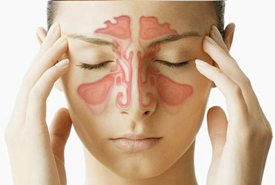 причини Симптоми і лікування гнійного синуситу причини Симптоми і лікування гнійного синуситу
