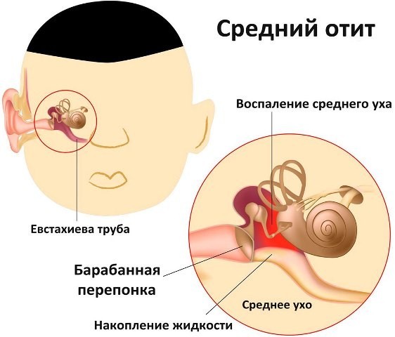 Причини симптоми і лікування очного болю при гаймориті