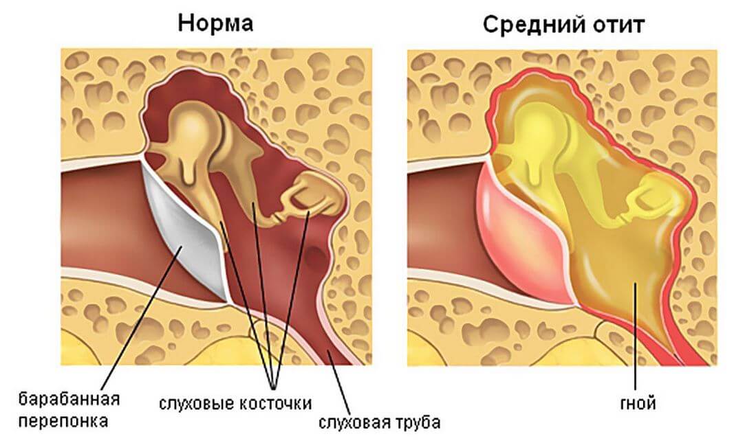 Причини симптоми і лікування очного болю при гаймориті