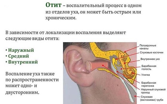 Причини симптоми і лікування отиту у дитини в домашніх умовах