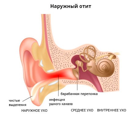 Причини симптоми і лікування отиту у дитини в домашніх умовах