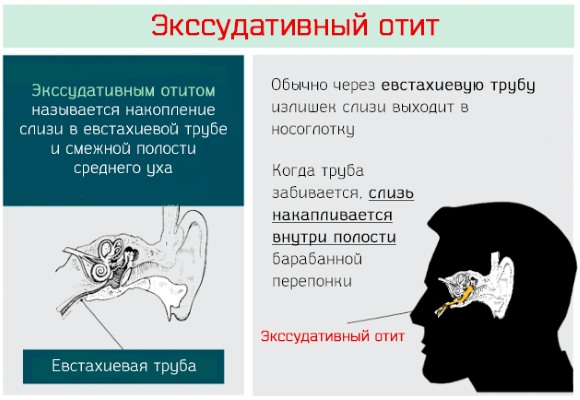 Причини симптоми і лікування отиту у дитини в домашніх умовах