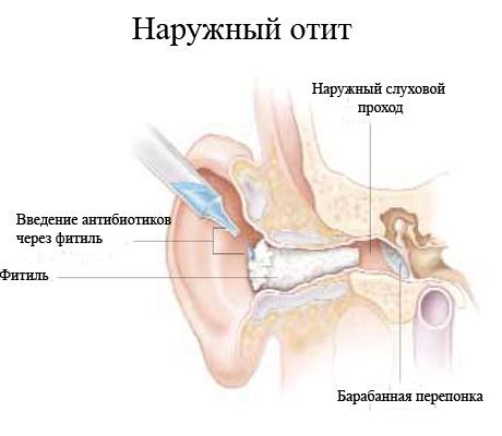 Причини симптоми і лікування отиту у дитини в домашніх умовах