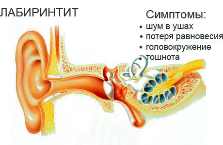 Причини симптоми і лікування отиту у дитини в домашніх умовах