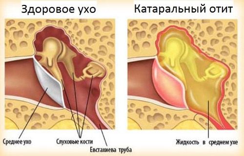 Причини симптоми і лікування отиту у дитини в домашніх умовах