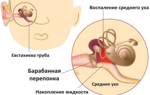 Причини симптоми і лікування отиту у дитини в домашніх умовах