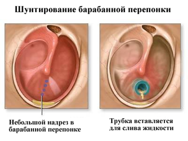 Причини симптоми і лікування отиту у дитини в домашніх умовах