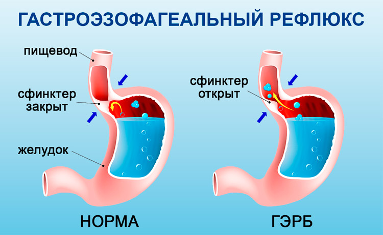 Причини спазму в горлі — чим зняти задуха