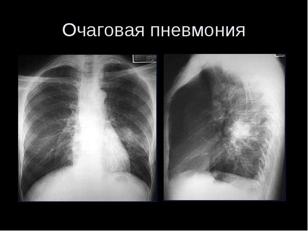 Причини та перші ознаки запалення легенів у дорослих Причини та перші ознаки запалення легенів у дорослих