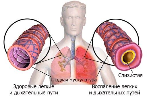 Причини та перші ознаки запалення легенів у дорослих