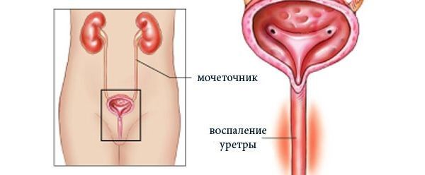 Причини утрудненого сечовипускання у жінок