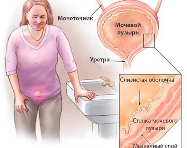 Причини утрудненого сечовипускання у жінок
