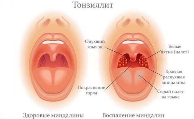 Причини виникнення болю в горлі з одного боку при ковтанні і е лікування