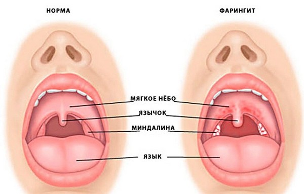 Причини виникнення болю в горлі з одного боку при ковтанні і е лікування