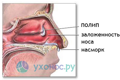 Причини виникнення та способи лікування поліпів у носі