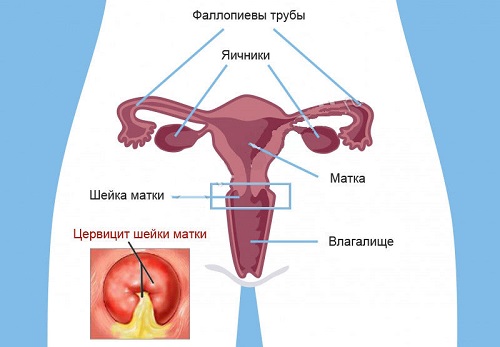 Причини запалення шийки матки симптоми та основні методи лікування