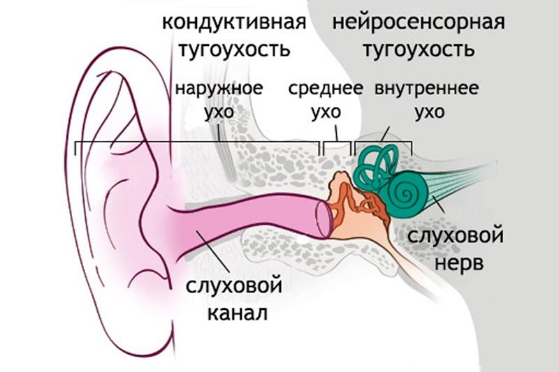 Приглухуватість 2 ступеня Чому вона виникає і як її правильно лікувати