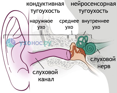 Приглухуватість 2 ступеня Чому вона виникає і як її правильно лікувати