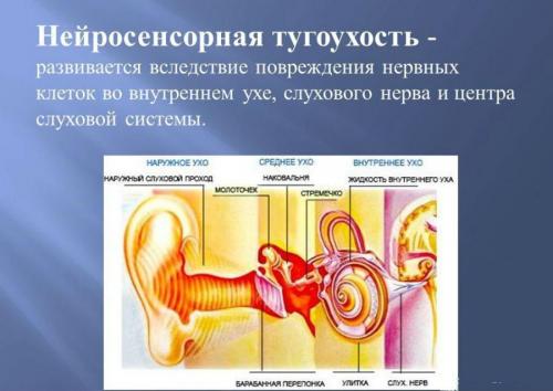 Приглухуватість 2 ступеня Чому вона виникає і як її правильно лікувати