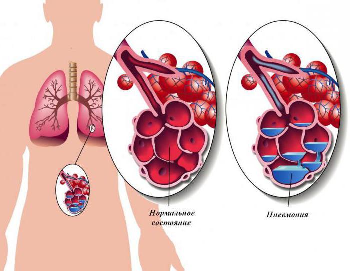 Прикоренева пневмонія ключові симптоми та підходи до лікування у дорослих