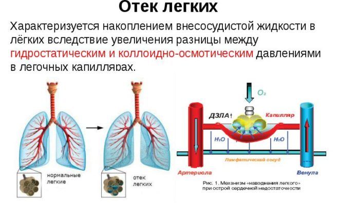 Про що говорить чорна мокротиння при кашлі