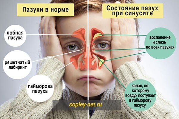 Про що говорять помаранчеві соплі і як він них позбутися?