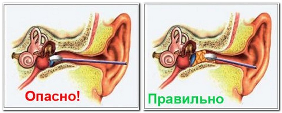 Про що свідчать виділення з вуха у дитини? Чому у дитини тече гній з вуха і що робити