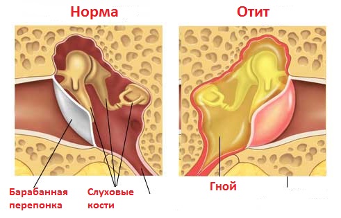 Про що свідчать виділення з вуха у дитини? Чому у дитини тече гній з вуха і що робити