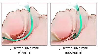 Про що свідчить постійна слиз носоглотки і що робити? Смачний морквяний салат від хропіння. Як лікувати слиз різної густоти і в залежності від причин її появи симптомів