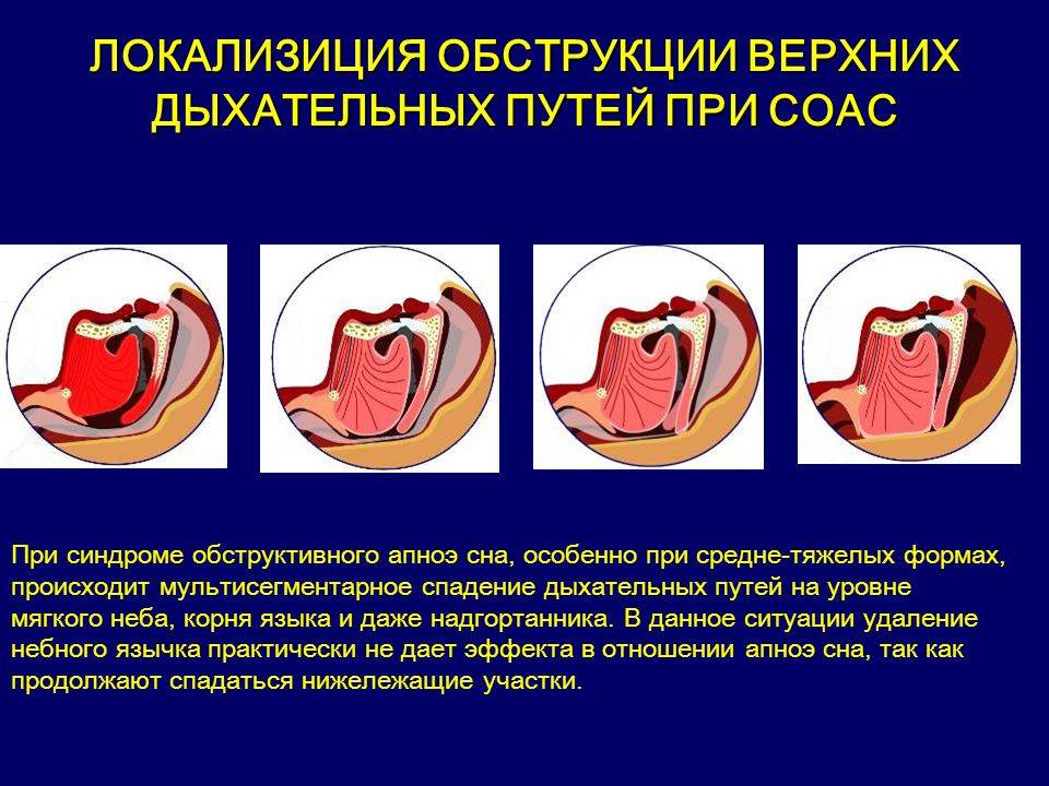 Про що свідчить постійна слиз носоглотки і що робити? Смачний морквяний салат від хропіння. Як лікувати слиз різної густоти і в залежності від причин її появи симптомів