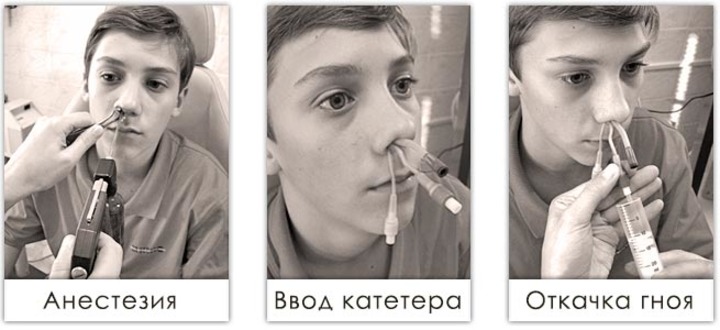 Процедура ямик при гаймориті Процедура ямик при гаймориті