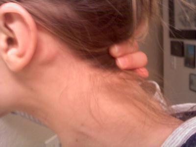 Профілактика причини і лікування жировиків за вухами