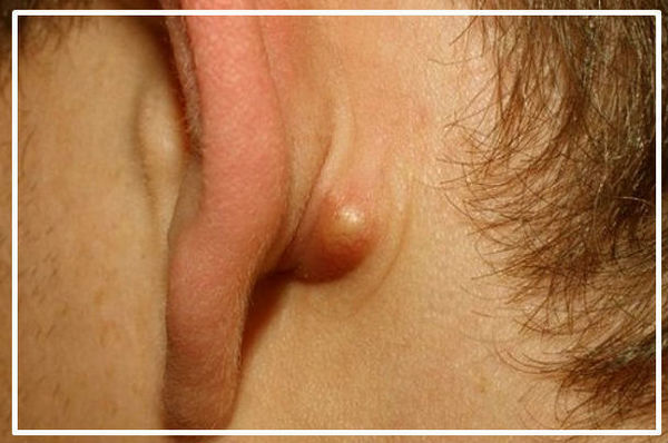 Профілактика причини і лікування жировиків за вухами