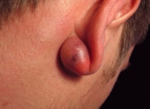 Профілактика причини і лікування жировиків за вухами