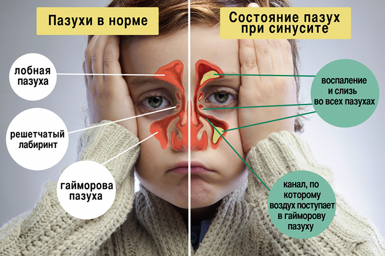 промивати ніс при гаймориті правильно. Важливі рекомендації