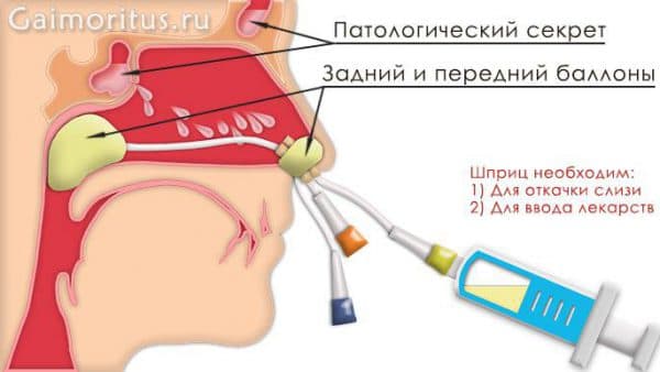промивати ніс при гаймориті правильно. Важливі рекомендації