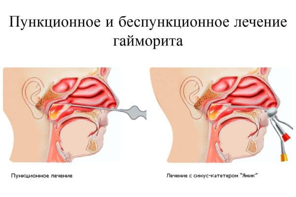 промивати ніс при гаймориті правильно. Важливі рекомендації